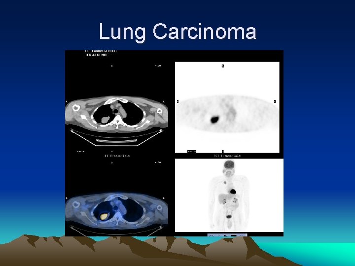 Lung Carcinoma 