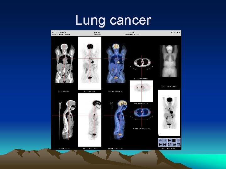 Lung cancer 