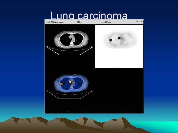 Lung carcinoma 