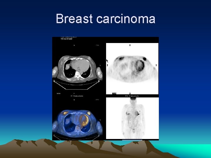 Breast carcinoma 