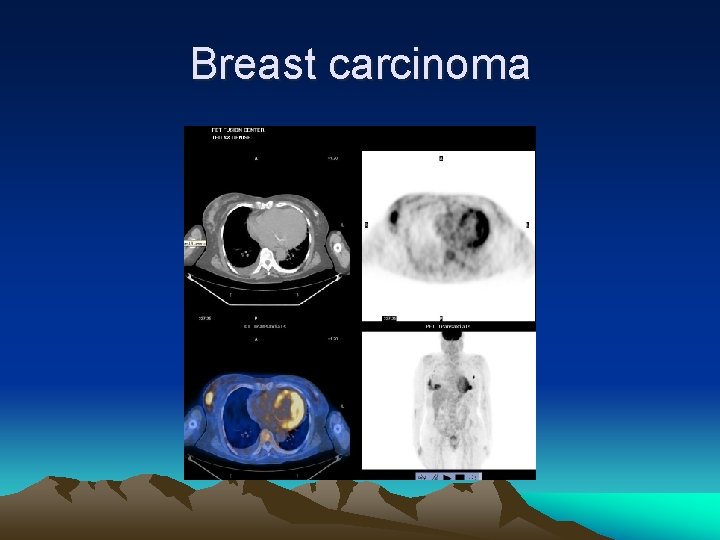 Breast carcinoma 