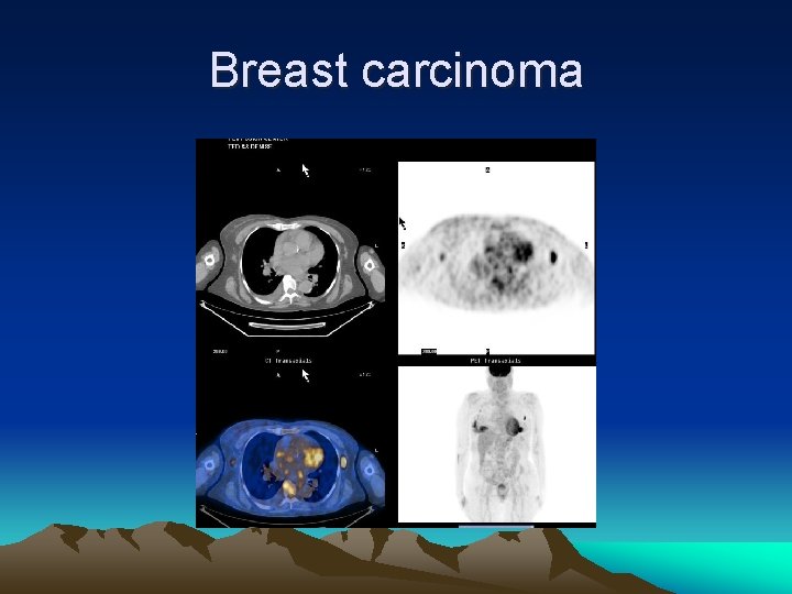 Breast carcinoma 