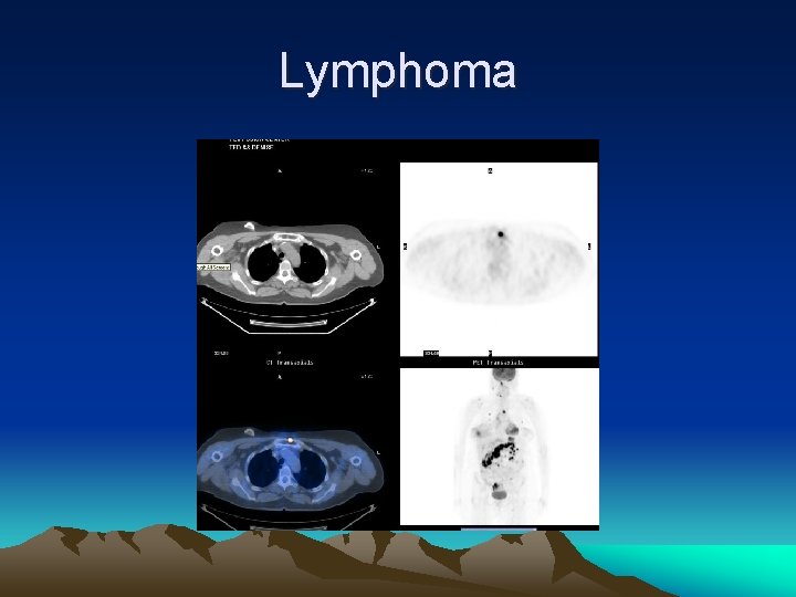 Lymphoma 