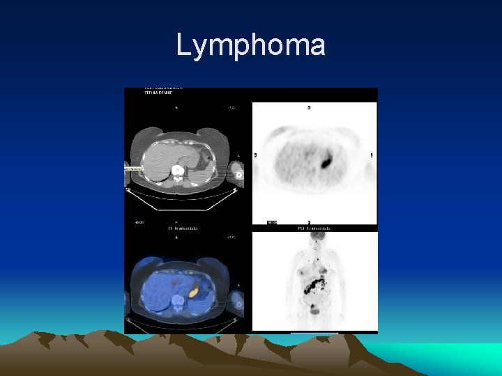 Lymphoma 