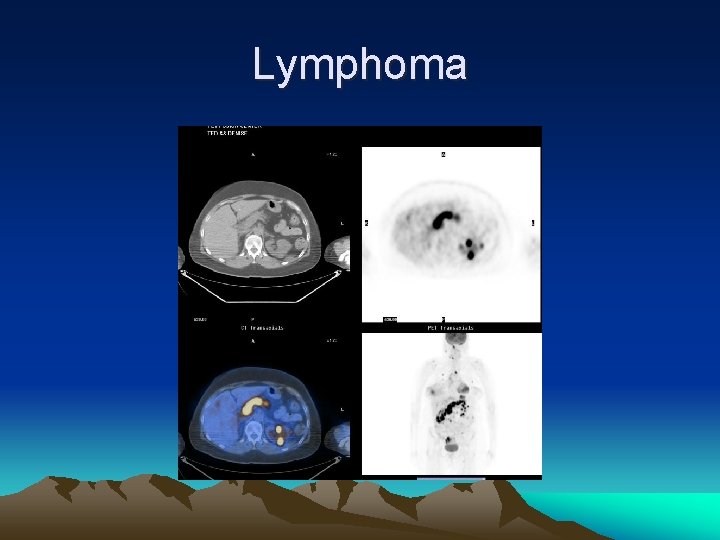 Lymphoma 