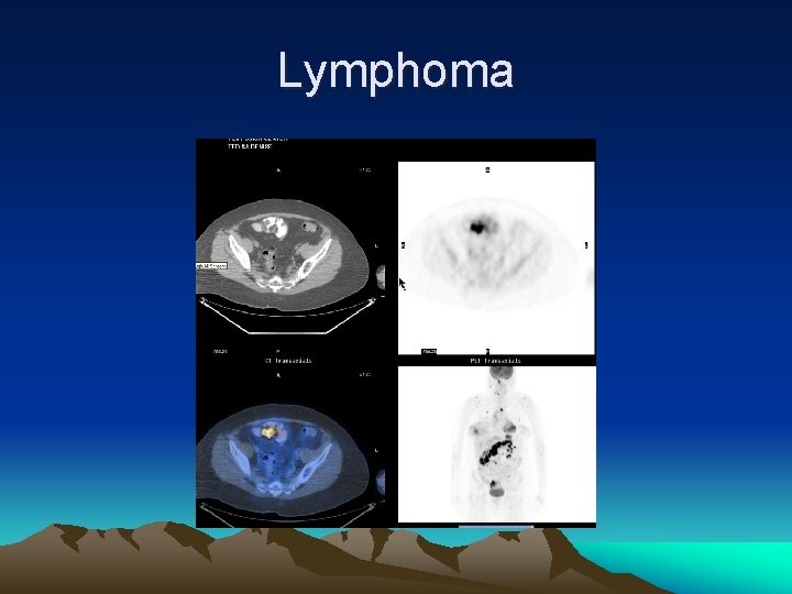 Lymphoma 