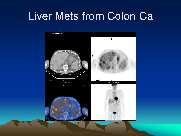 Liver Mets from Colon Ca 