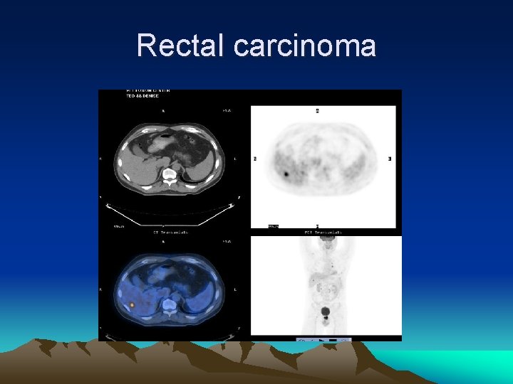 Rectal carcinoma 