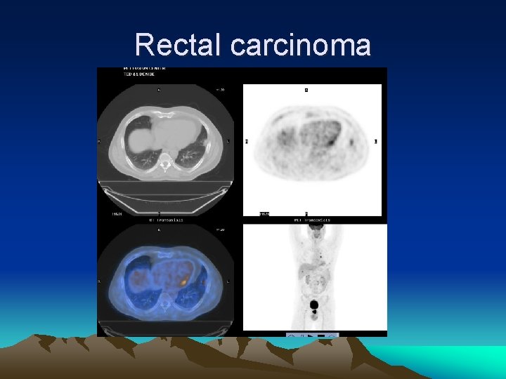 Rectal carcinoma 