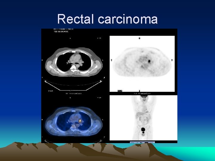 Rectal carcinoma 