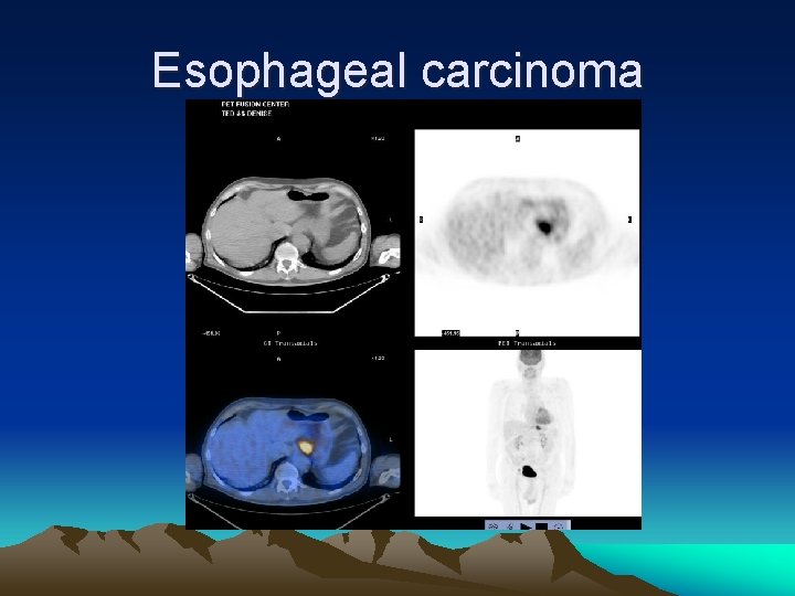 Esophageal carcinoma 