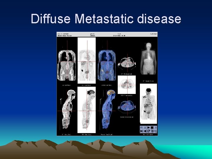 Diffuse Metastatic disease 