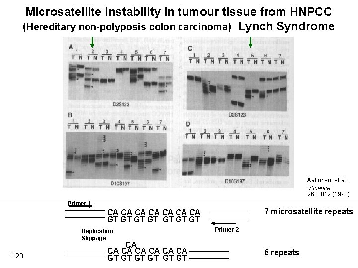 Microsatellite instability in tumour tissue from HNPCC (Hereditary non-polyposis colon carcinoma) Lynch Syndrome Aaltonen,