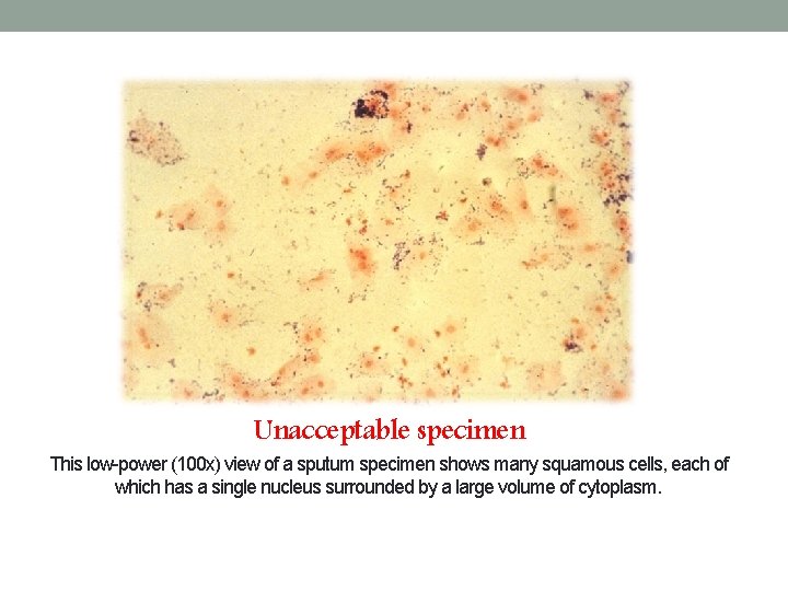 Unacceptable specimen This low-power (100 x) view of a sputum specimen shows many squamous