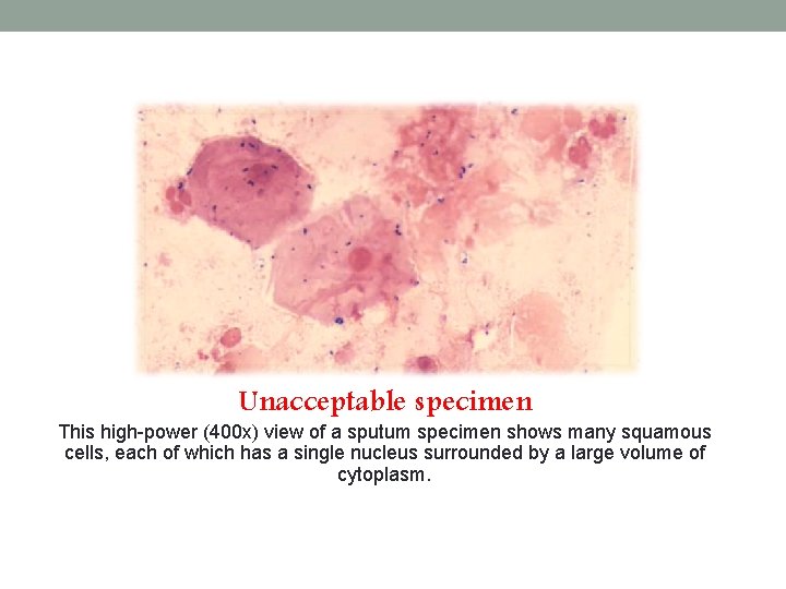 Unacceptable specimen This high-power (400 x) view of a sputum specimen shows many squamous