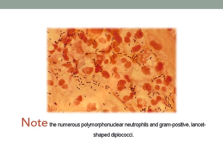 Note the numerous polymorphonuclear neutrophils and gram-positive, lancetshaped diplococci. 