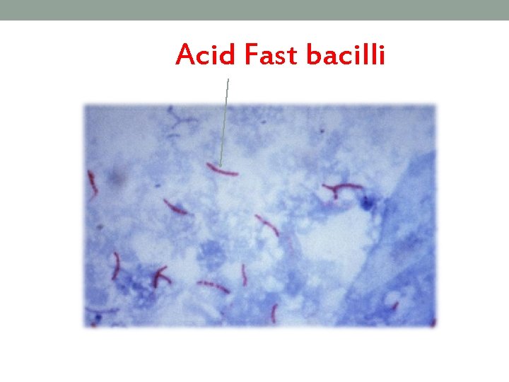 Acid Fast bacilli 