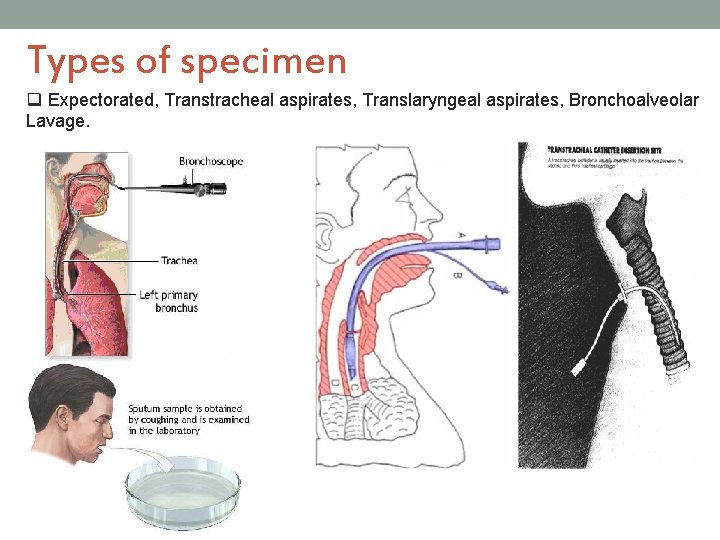 Types of specimen q Expectorated, Transtracheal aspirates, Translaryngeal aspirates, Bronchoalveolar Lavage. 
