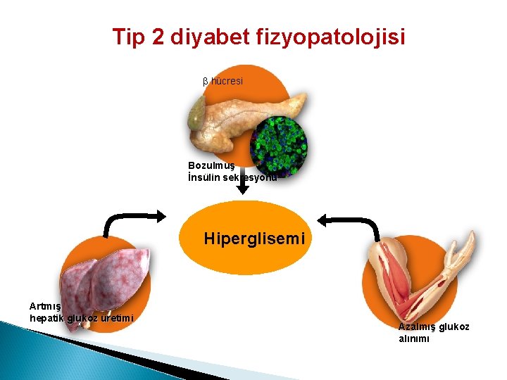 Tip 2 diyabet fizyopatolojisi b hücresi Bozulmuş İnsülin sekresyonu Hiperglisemi Artmış hepatik glukoz üretimi