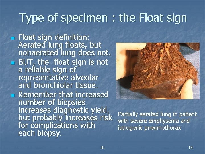 Type of specimen : the Float sign n Float sign definition: Aerated lung floats,