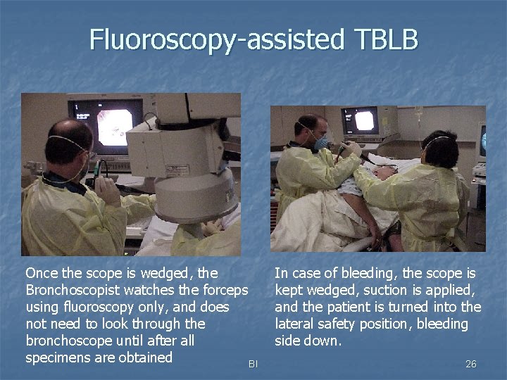 Fluoroscopy-assisted TBLB Once the scope is wedged, the Bronchoscopist watches the forceps using fluoroscopy