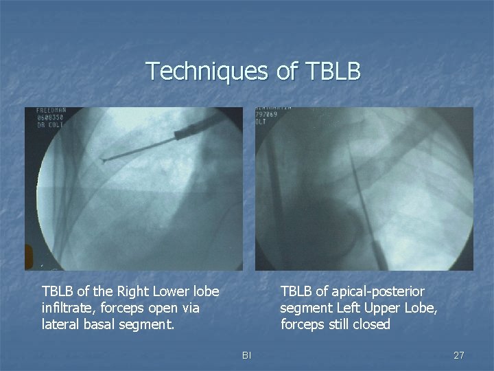 Techniques of TBLB of the Right Lower lobe infiltrate, forceps open via lateral basal