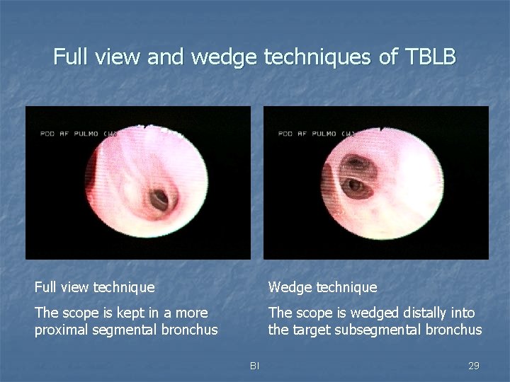 Full view and wedge techniques of TBLB Full view technique Wedge technique The scope