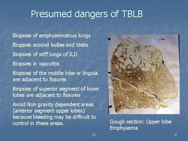 Presumed dangers of TBLB Biopsies of emphysematous lungs Biopsies around bullae and blebs Biopsies