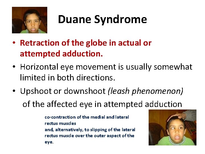 Duane Syndrome • Retraction of the globe in actual or attempted adduction. • Horizontal