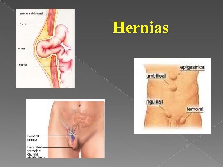 Hernias 