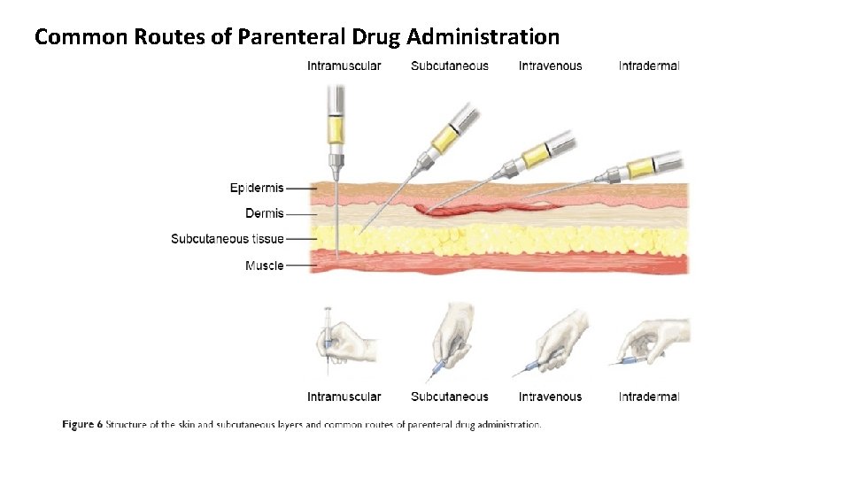 Common Routes of Parenteral Drug Administration 
