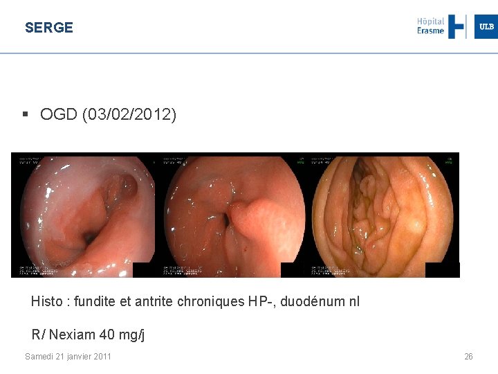 SERGE § OGD (03/02/2012) Histo : fundite et antrite chroniques HP-, duodénum nl R/