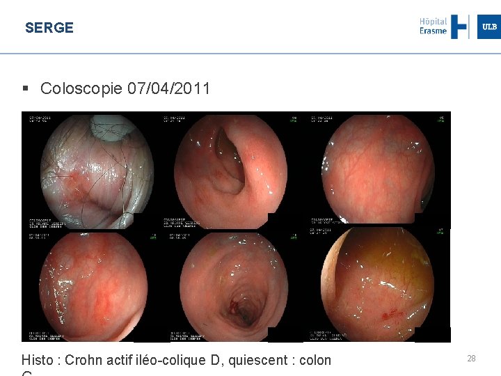 SERGE § Coloscopie 07/04/2011 Histo : Crohn actif iléo-colique D, quiescent : colon 28