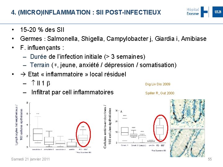 4. (MICRO)INFLAMMATION : SII POST-INFECTIEUX • 15 -20 % des SII • Germes :