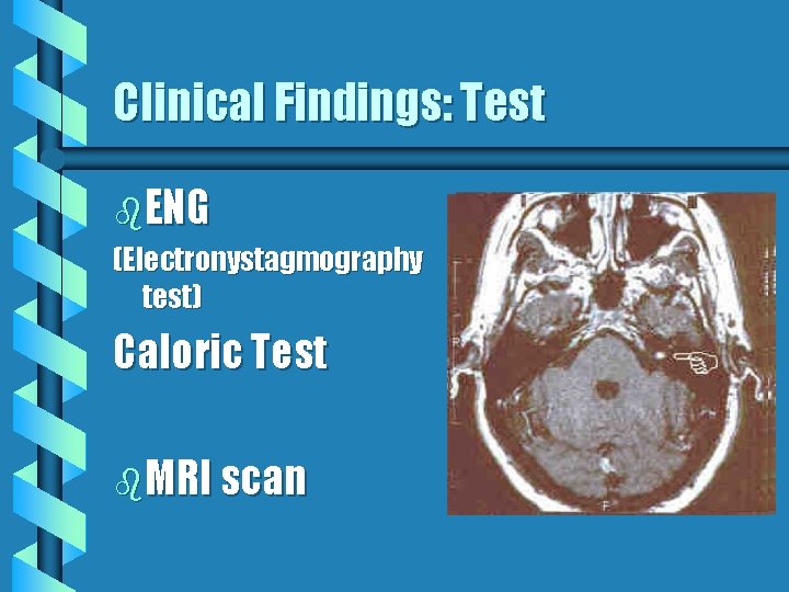 Clinical Findings: Test b. ENG (Electronystagmography test) Caloric Test b. MRI scan 