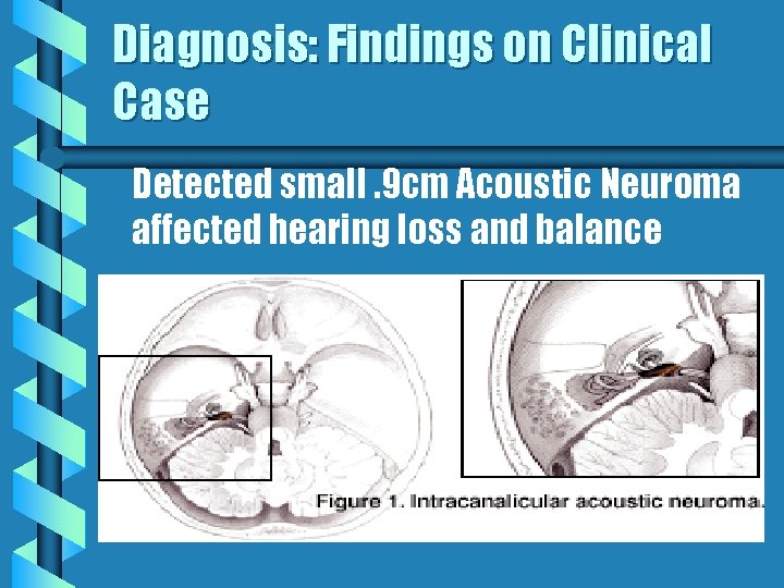 Cranial Nerve Lesion Acoustic Neuroma Presented By Emma