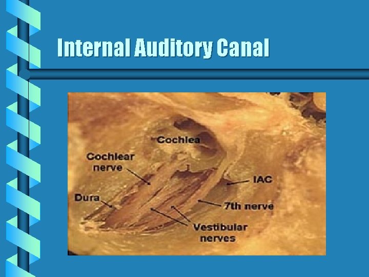 Internal Auditory Canal 