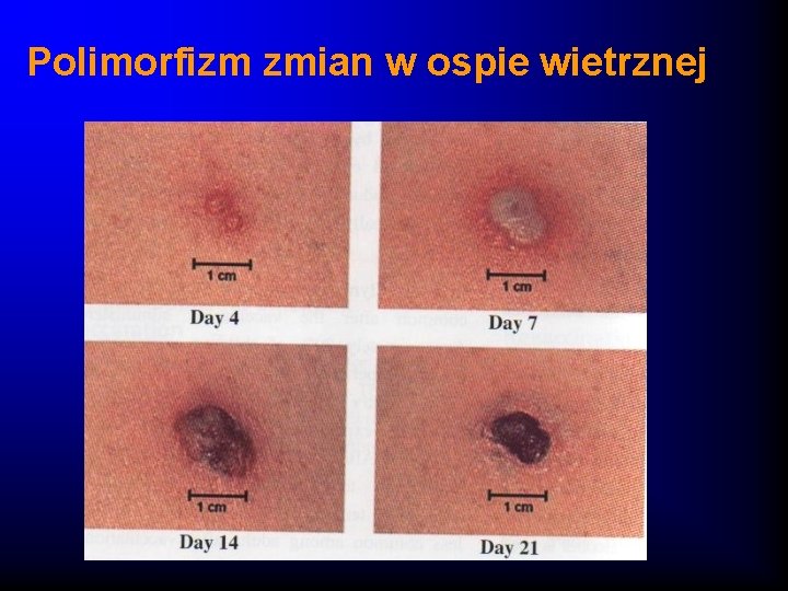 Polimorfizm zmian w ospie wietrznej 