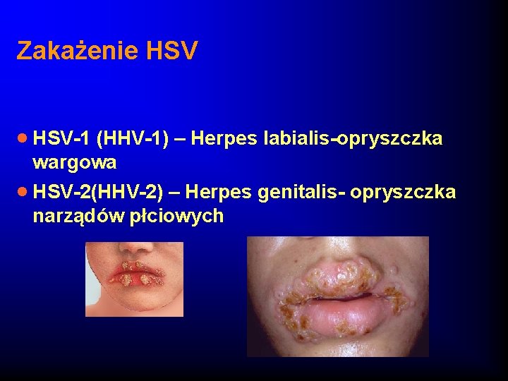 Zakażenie HSV · HSV-1 (HHV-1) – Herpes labialis-opryszczka wargowa · HSV-2(HHV-2) – Herpes genitalis-