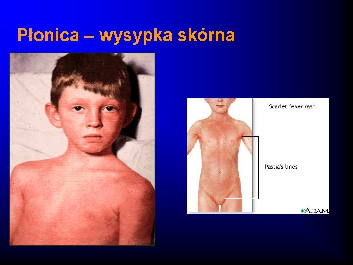 Płonica – wysypka skórna 