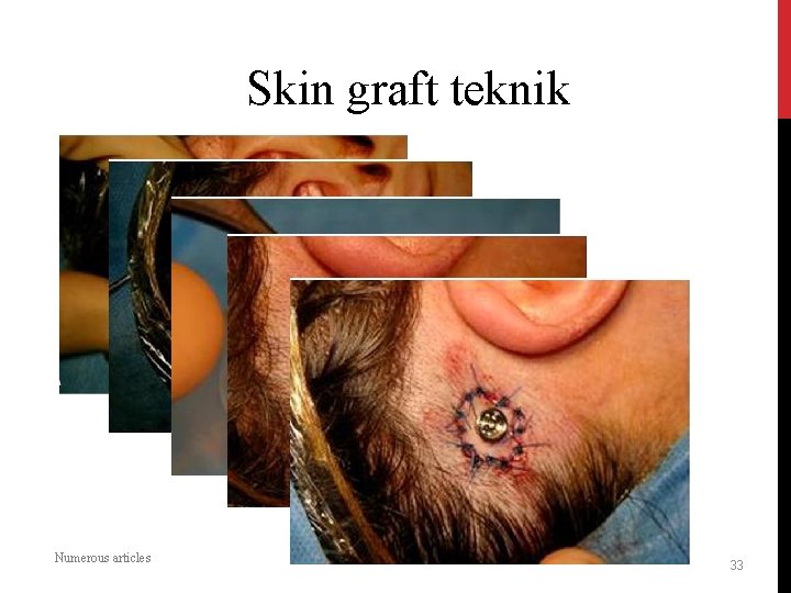 Skin graft teknik Numerous articles 33 