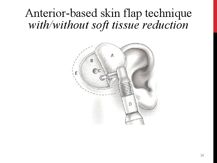 Anterior-based skin flap technique with/without soft tissue reduction 34 