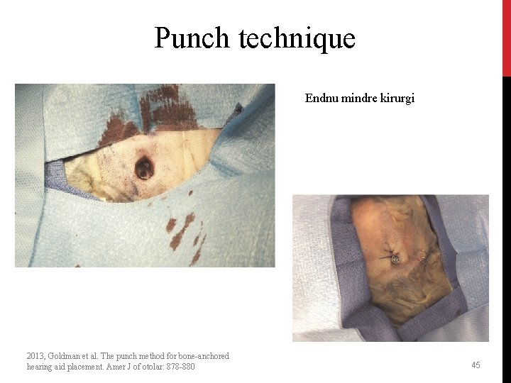 Punch technique Endnu mindre kirurgi 2013, Goldman et al. The punch method for bone-anchored