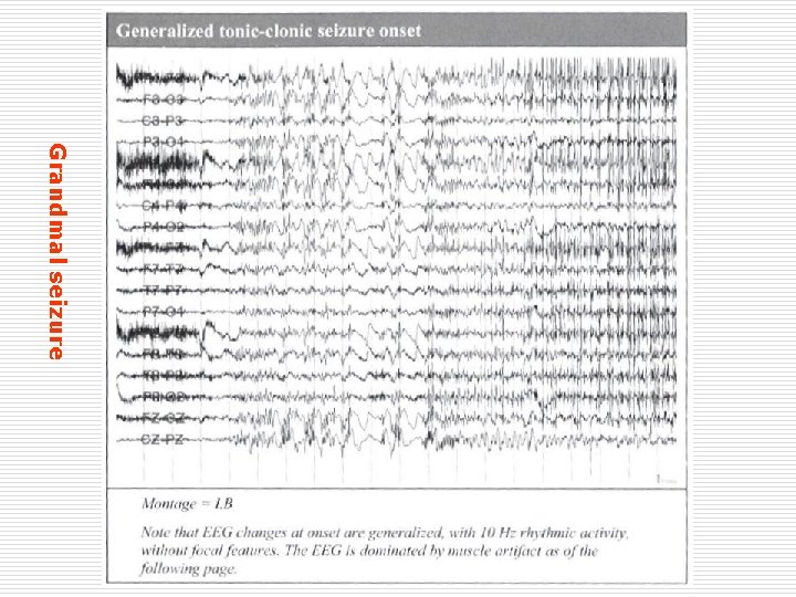 Grandmal seizure 