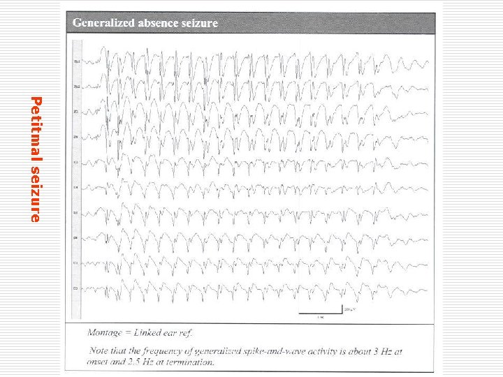 Petitmal seizure 