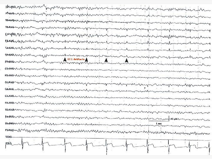 ECG Artifacts 