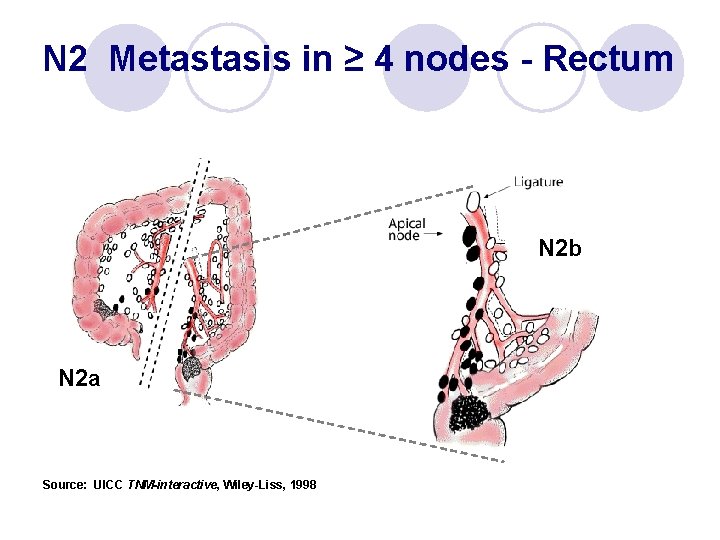 N 2 Metastasis in ≥ 4 nodes - Rectum N 2 b N 2