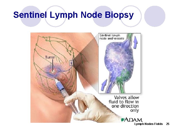 Sentinel Lymph Node Biopsy Lymph Nodes Fields 25 