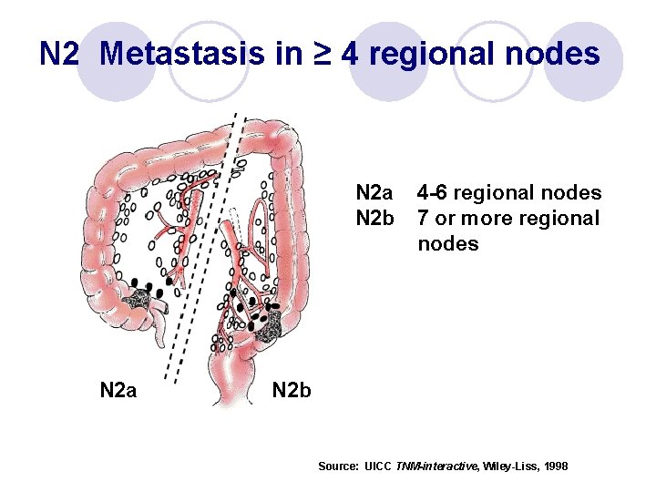 N 2 Metastasis in ≥ 4 regional nodes N 2 a N 2 b