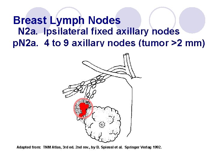 Breast Lymph Nodes N 2 a. Ipsilateral fixed axillary nodes p. N 2 a.